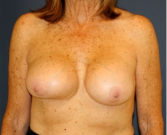 Feel Beautiful - Areola Lift with Breast Implants 56 - Before Photo